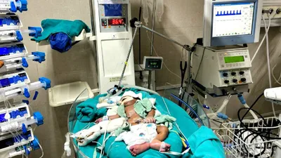 mdmh के डॉक्टरों का कमाल…aiims में जन्मे 9 दिन के बच्चे की हार्ट सर्जरी सफल  उल्टी थी धमनियां