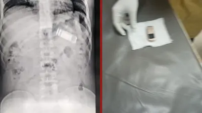 सेंट्रल जेल के कैदी का x ray देख मचा हड़कंप  पेट में दिखा मोबाइल  एंडोस्कॉपी कर डॉक्टरों ने निकाला